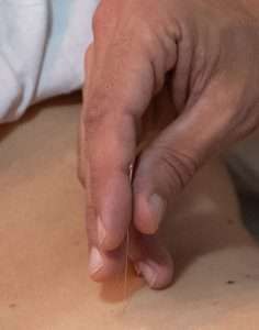 Aplicación de una aguja de acupuntura en Barcelona Poble Sec