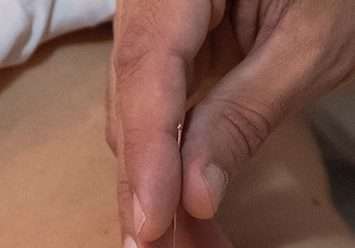 Mano de Nicolas Dréan sujetando una aguja de acupuntura insertada en la piel de alguien